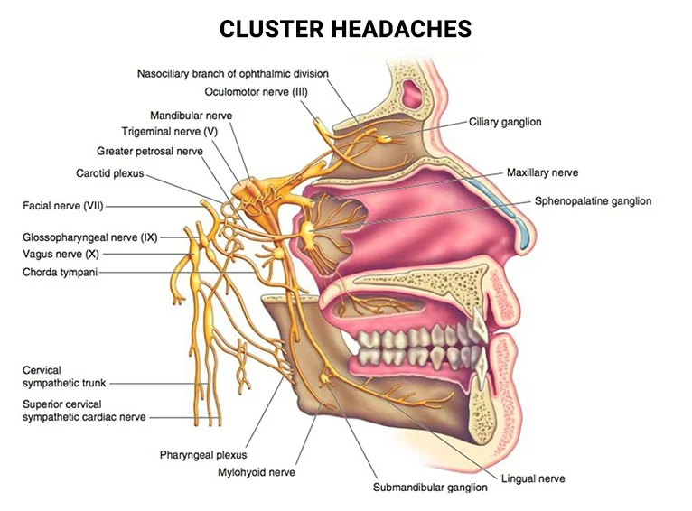 Cluster Headaches