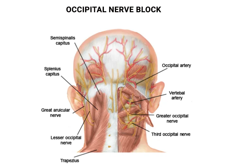 Occipital Nerve Block