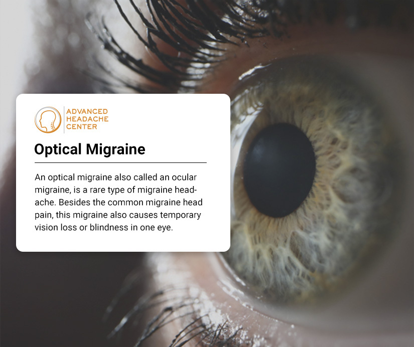 What Is An Ocular Migraine?